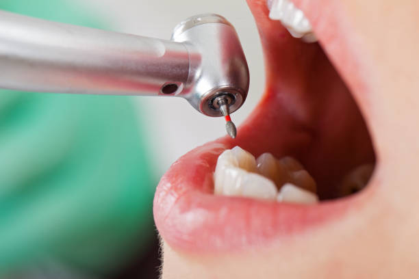 Best Emergency Cosmetic Dentistry (e.g., broken veneers) in Olathe, CO